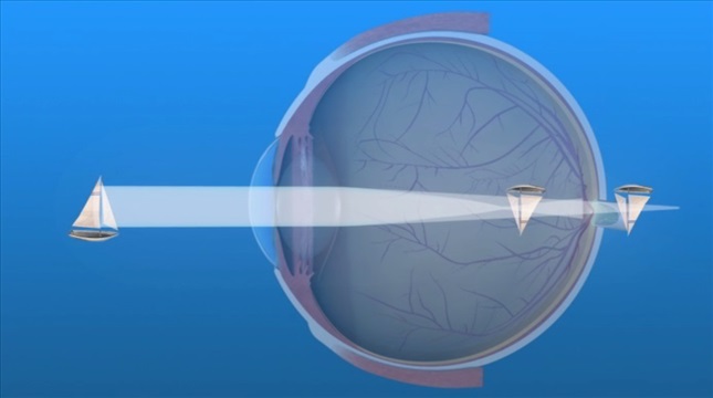 astigmatismo con due linee di fuoco