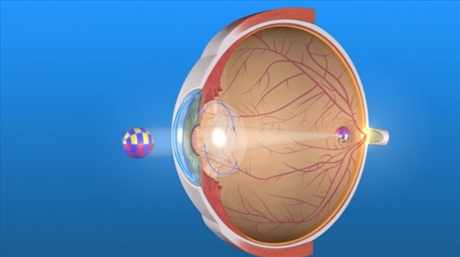 cristallino artificiale e immagine nitida