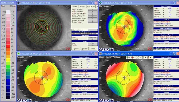 astigmatismo in topografia corneale