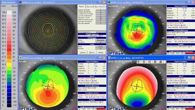 cheratocono in topografia corneale