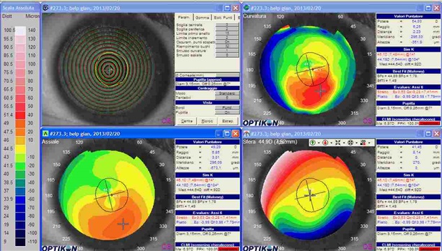 cheratocono in topografia corneale